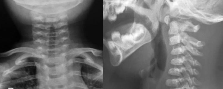 Radiografía de columna cervical frente y perfl