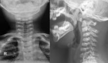 Radiografía de columna cervical frente y perfl
